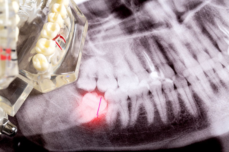 This image shows an X-ray of teeth with a highlighted wisdom tooth at the bottom left. A dental model is also partially visible, emphasizing the impacted wisdom tooth and its location. The red marking indicates the area of concern for extraction.