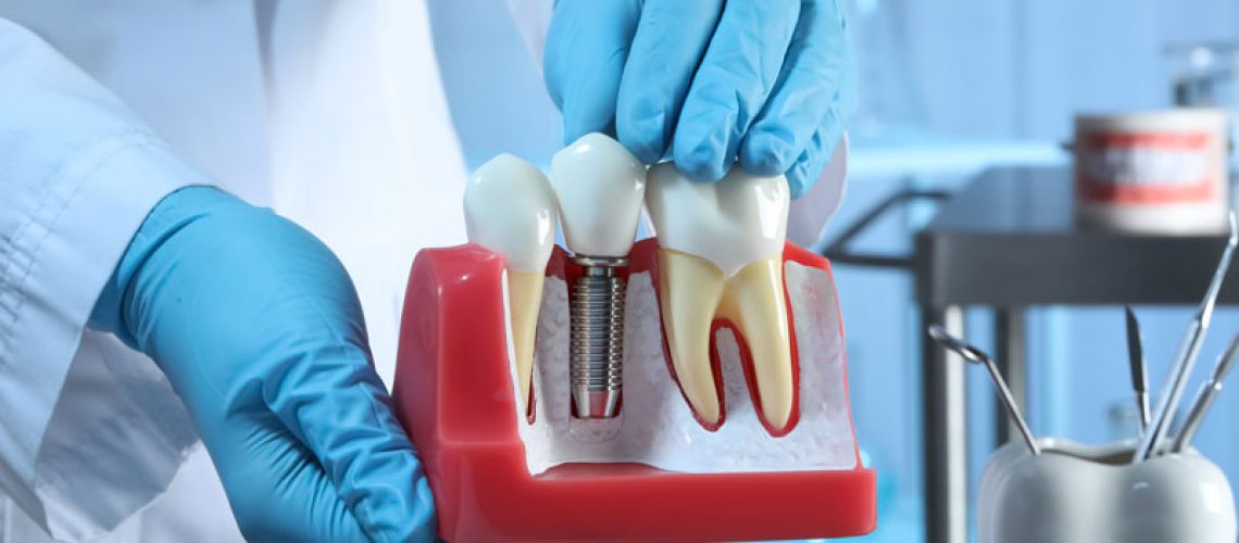 The image shows a person in blue gloves holding a dental implant model next to natural teeth, demonstrating how dental implants work. The setting appears to be a dental clinic.