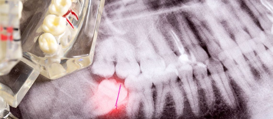 This image shows an X-ray of teeth with a highlighted wisdom tooth at the bottom left. A dental model is also partially visible, emphasizing the impacted wisdom tooth and its location. The red marking indicates the area of concern for extraction.